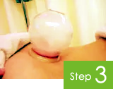 とみ鍼灸治療院 治療の流れstep3